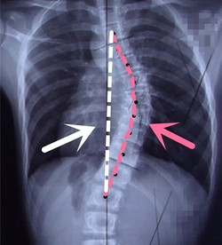 脊柱側(cè)彎后身高會變短嗎？