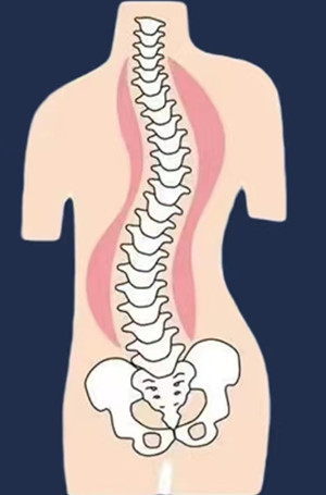 如何有效改善脊柱側彎