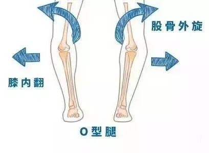 孩子“O”型腿怎么辦？