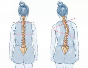 怕耽誤學(xué)習(xí)，脊柱側(cè)彎就不治療了嗎？